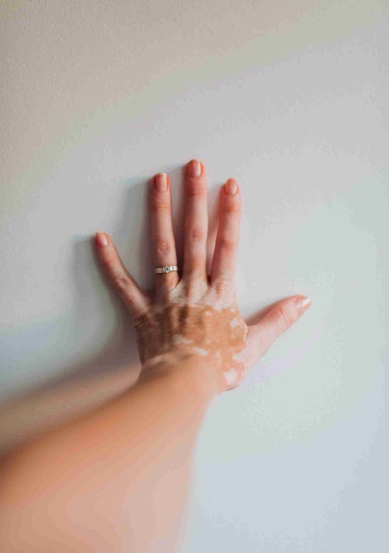 A New Cream Offering Hope for Vitiligo Patients on the NHS